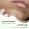 نحوه استفاده گلاب برای جوش صورت