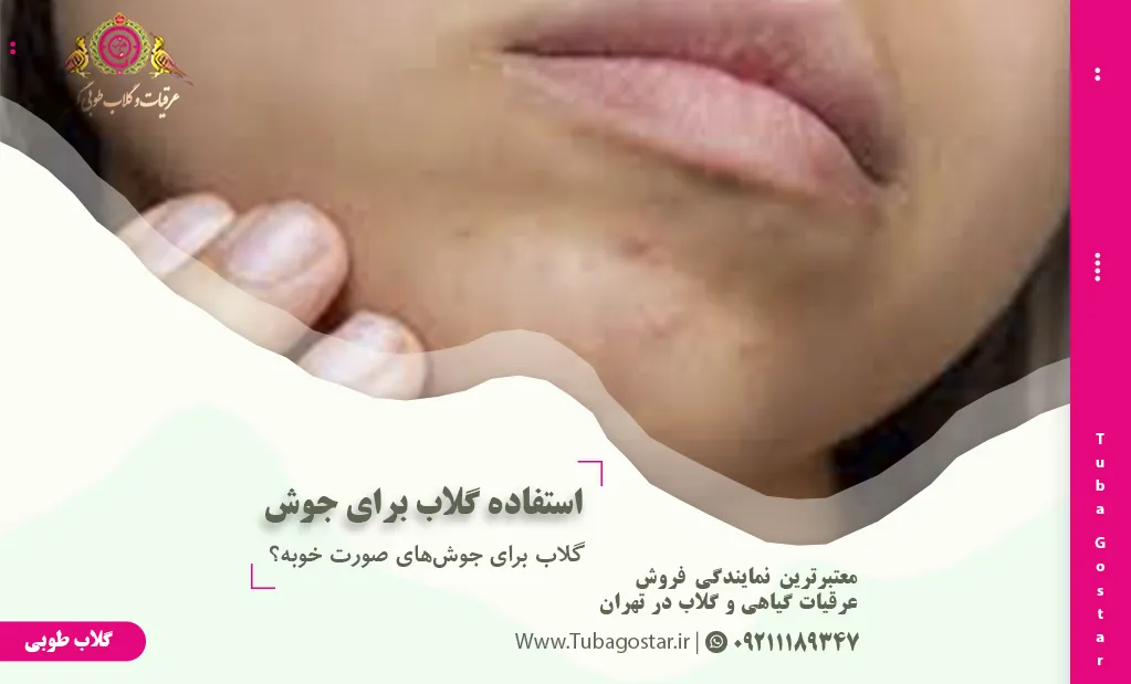 نحوه استفاده گلاب برای جوش صورت